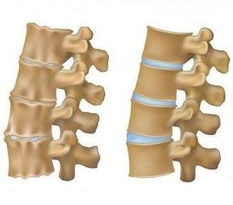 Лечение остеоартроза позвоночника