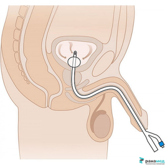 Катетер Фолея силиконовый двухходовой MEDEREN, Ch/Fr 16, объем баллона 30 мл (Израиль)