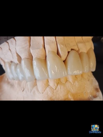 YUCERA UT Multilayer - Идеальный выбор для реставраций передних зубов