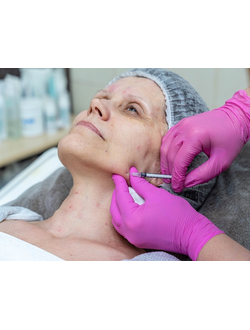 Коррекция мимических морщин препаратом Миотокс