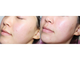 Омолаживающий крем для лица от угрей, антибактериальный анти-акне, от прыщей и воспалений  BIOAQUA Pure Skin Acne Rejuvenation & Cream (30 мл.)