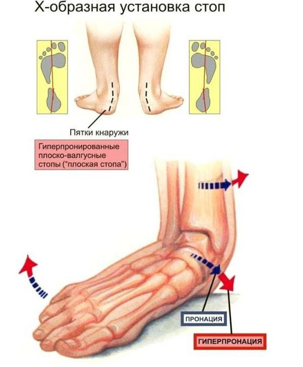 Деформация по типу плосковальгусной стопы