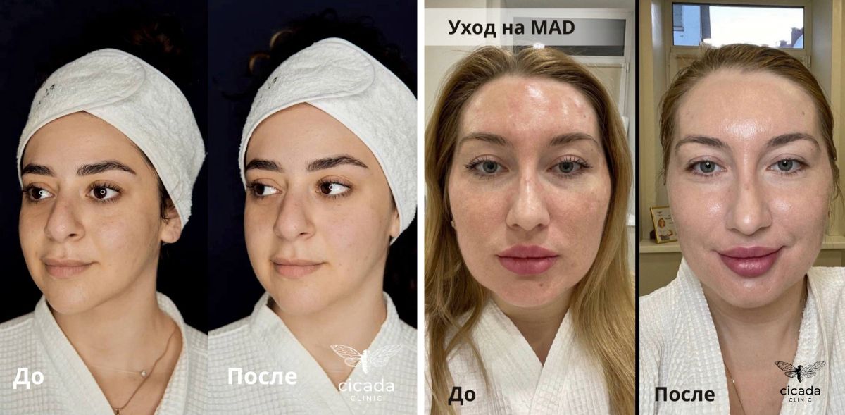Уход на дерматокосмецевтике M.A.D в Cicada Clinic