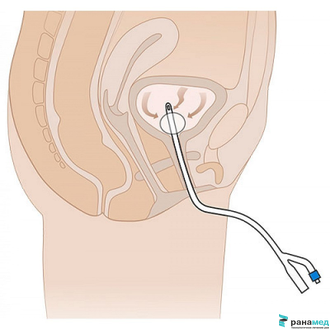 Катетер Фолея силиконовый двухходовой MEDEREN, Ch/Fr 14, объем баллона 5-15 мл (Израиль)