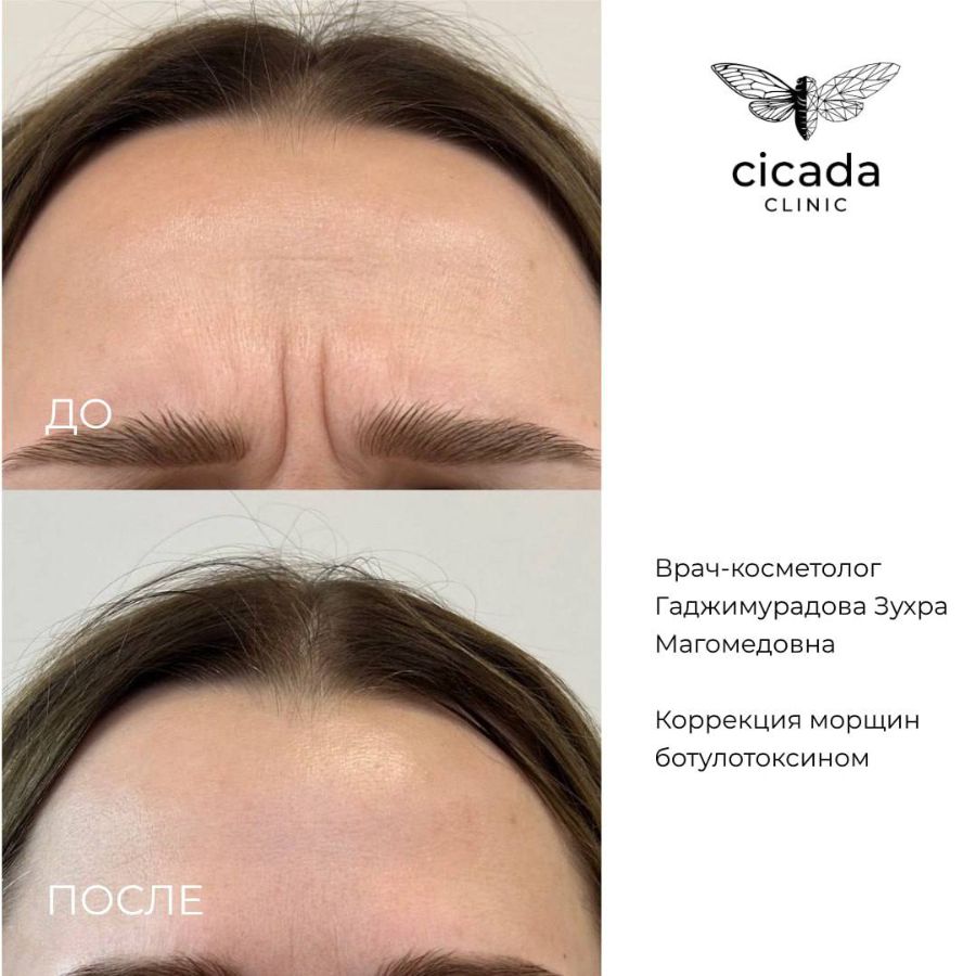 БОТОКС Гаджимурадова Зухра Магомедовна   Врач-Косметолог,  Дерматовенеролог cicada clinic