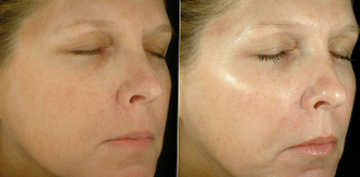 Упругость, регенерация и омоложение кожи: гиалуроновая кислота с биозолотом и альгинатная маска для лица