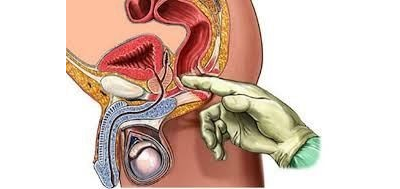 Фитокомплекс №21 для лечения аденомы предстательной железы, простатита