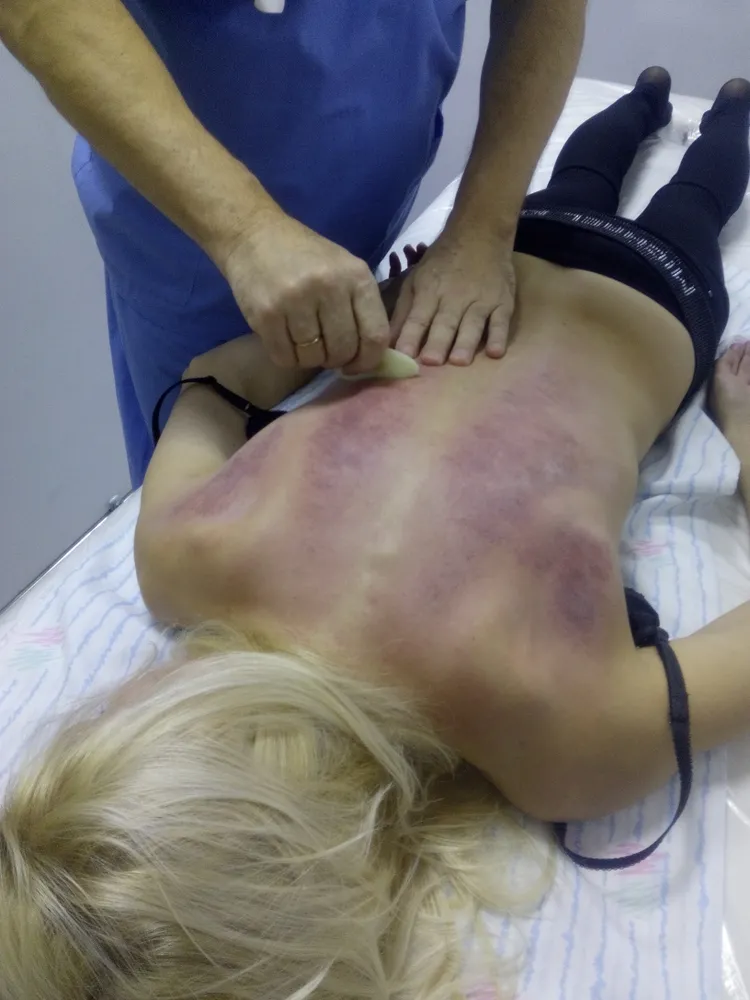 Массаж гуаша нефритовым скребком.