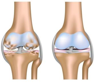 Лечение артрита коленных суставов