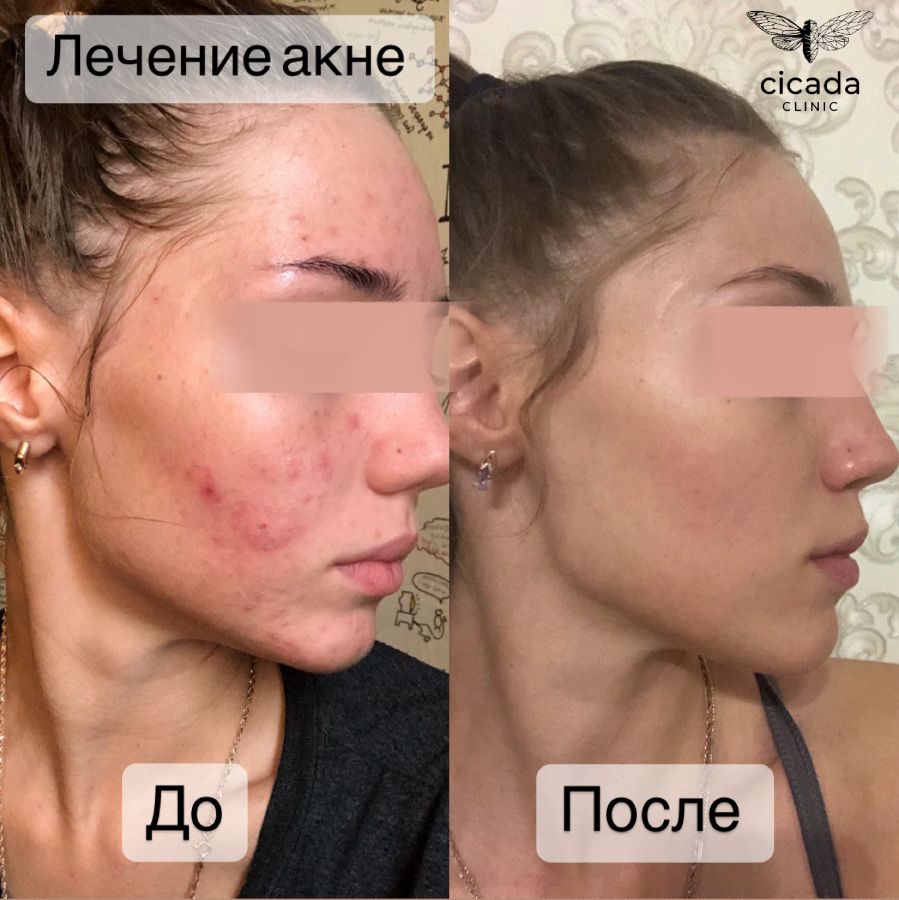 Консультация Врача-Дерматолога в Cicada Clinic
