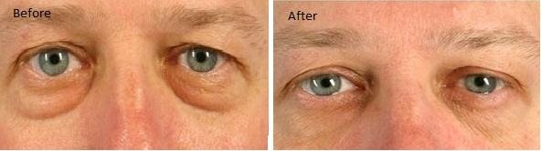 Dermaheal Eyebag Solution — Mesotherapy Enhancer | Caregen Korea