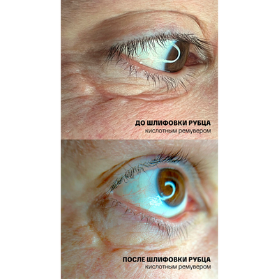 Ремувер с гликолевой кислотой 11% (GLYCOLIC ACID REMOVER) AS Company, 6 мл