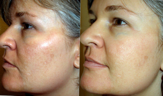 Регенерация, упругость, увлажнение и омоложение кожи: 2 шт. Гиалуроновая кислота с Био-золотом (20мл) + альгинатная маска для лица