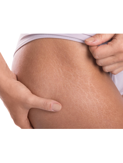 Коррекция стрий (растяжек)