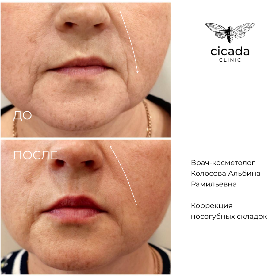Результат процедур - Контурная пластика лица в Cicada Clinic Цикада Клиник Тверь