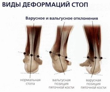 Варианты деформаций голеностопа