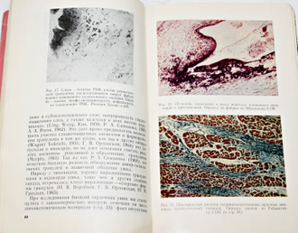 Грицман Н. Поражения сердца при коллагеновых заболеваниях. М.: Москва. 1971г.