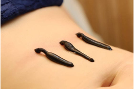 Гирудооздоровление