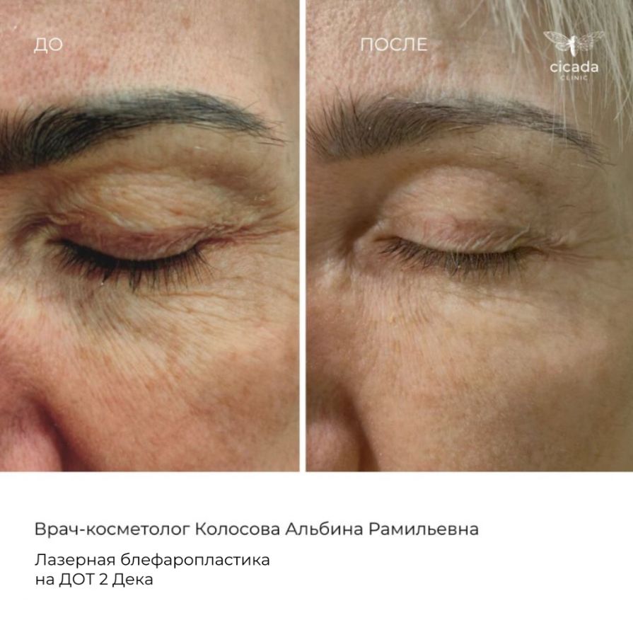 Записаться на процедуру Лазерная шлифовка - в Cicada Clinic