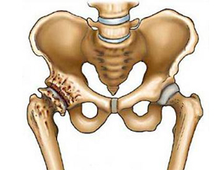 Лечение коксартроза тазобедренного сустава