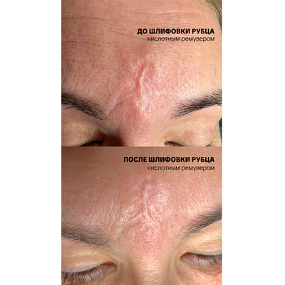 Ремувер с гликолевой кислотой 11% (GLYCOLIC ACID REMOVER) AS Company, 6 мл