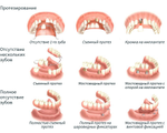 Протезирование зубов (ортопедия)