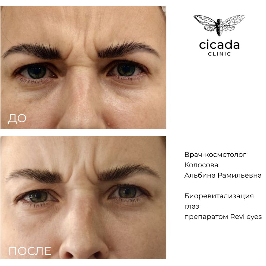 Результат процедуры - Биоревитализация Цикада Клиник Тверь