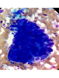 ЦИТОЛОГИЧЕСКАЯ КАРТИНА ПАТОЛОГИИ КОЖИ (ч.1): многоликая базалиома.