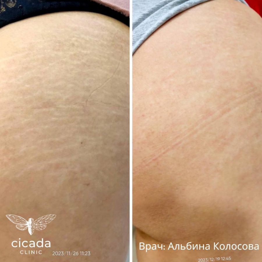 Записаться на процедуру Лазерная шлифовка - в Cicada Clinic