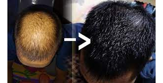 Morr F 5%/Морр Ф 5%, липидный раствор от облысения, для восстановления роста волос, 60 мл