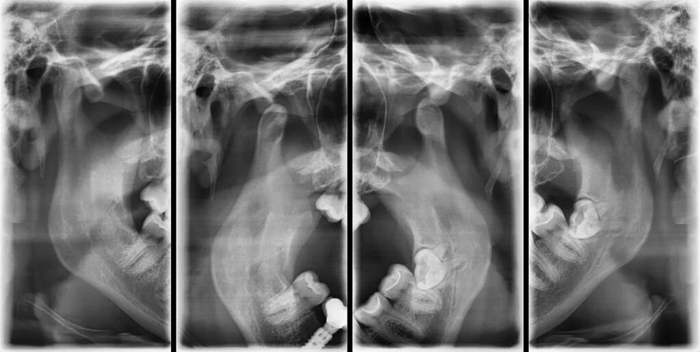 Подключичный катетер рентген. Два рентгена подряд. Рентген снимки. Подготовка пациента к рентгенографии грудной клетки. Рентгеновские снимки женщин.