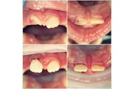 Травма зуба