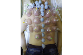 Магнитные банки аккупункционного действия и комплексные банки