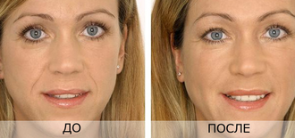 Сыворотка для лица с гиалуроновой кислотой в шприце Images (10 ml). Эффект увлажнения, омоложения