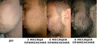 Миноксидил Киркланд «MINOXIDIL» KIRKLAND— средство для роста волос/бороды для мужчин