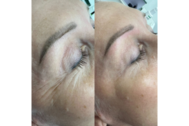 Безинъекционное омоложение лица с пептидной сывороткой Cleopine. Фото до и после