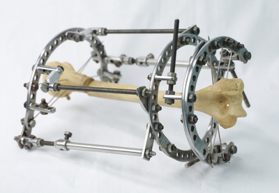 аппарат илизарова, стержень телескопический, удлинение конечностей, ЦИТО, РНЦ ВТО, илизаров, аппарат