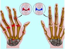 Лечение артрита кистей рук