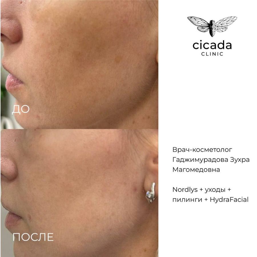 Гаджимурадова Зухра Магомедовна   Врач-Косметолог,  Дерматовенеролог cicada clinic