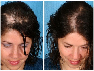 Дермаштамп - 0,5 мм (derma stamp) титановые иглы с серебряным напылением. Для головы и лица
