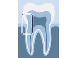 Насадки для удаления зубных отложений к ультразвуковым скалерам Varios NSK