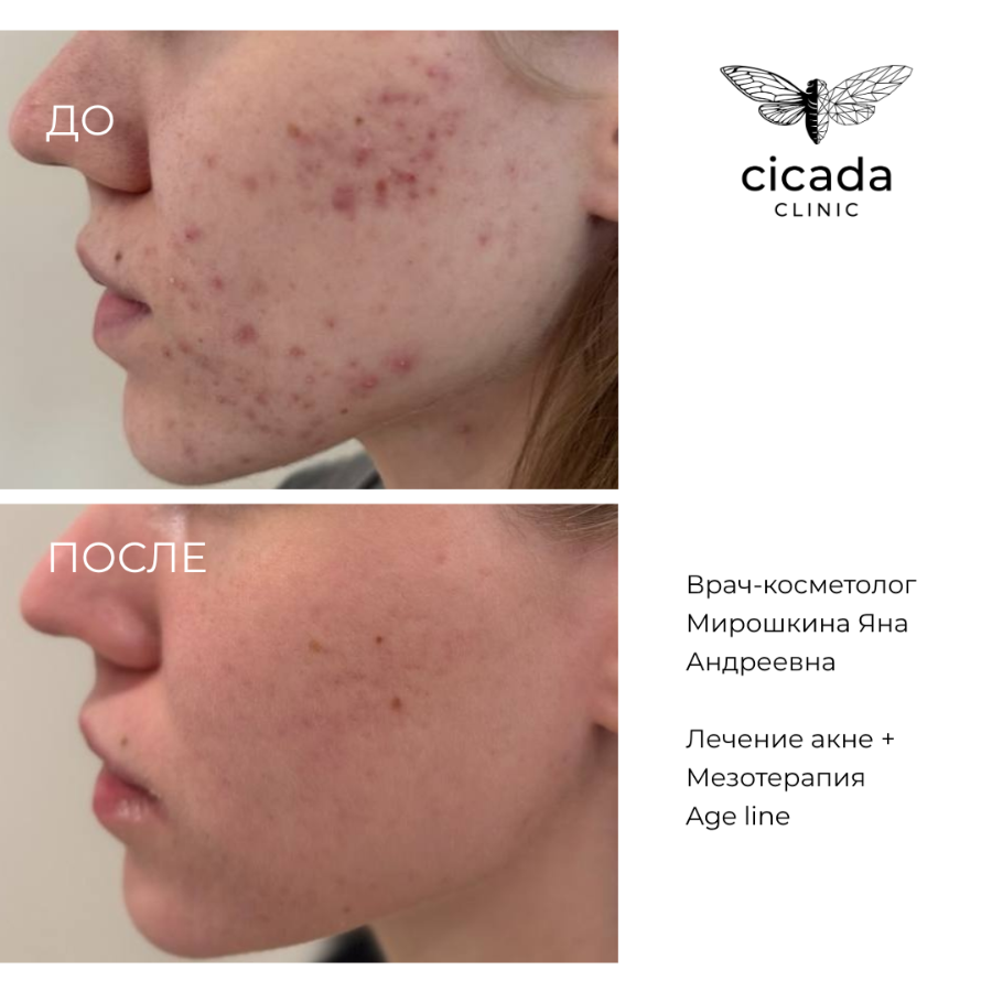 Результат процедур - Инъекционная мезотерапия в Цикада Клиник 