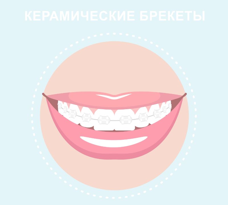 Керамические брекеты плюсы и минусы, цена брекеты