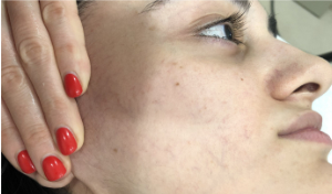 Фотоомоложение лица - Nordlys в Cicada Clinic