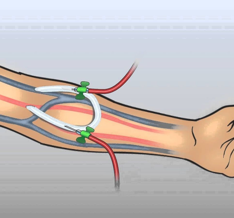 Артериовенозный шунт. Артериовенозная фистула диализ. Артериально венозная фистула. Артериовенозный шунт для гемодиализа.