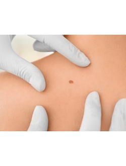 Удаление  доброкачественных образований кожи