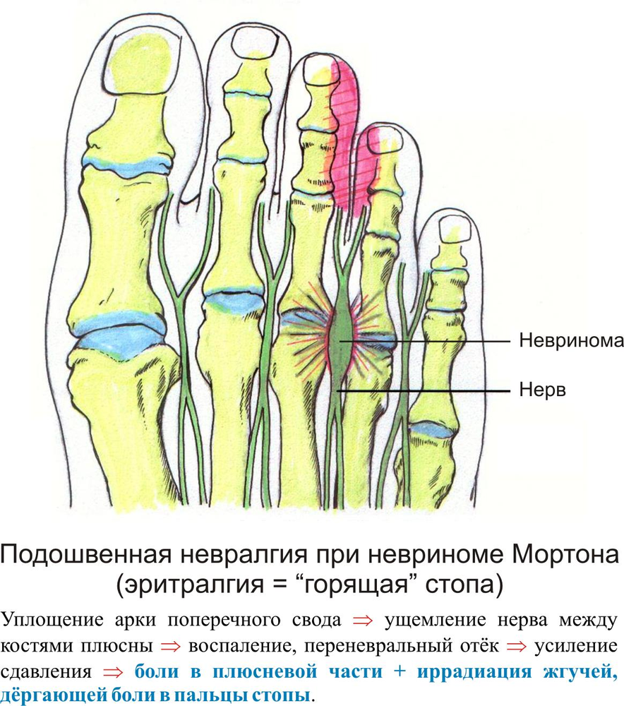 Почему болит палец на правой ноге. Невринома Мортона стопы. Неврома Мортона операция. Болезни стопы неврома Мортона. Защемление нерва с Топе.