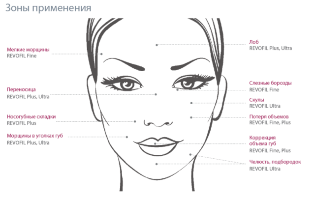 Филлеры схема. Схема введения филлеров в лицо. Скулы схема введения. Скулы филлерами схема. Коррекция скул схема.