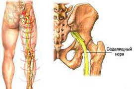 Защемление седалищного нерва