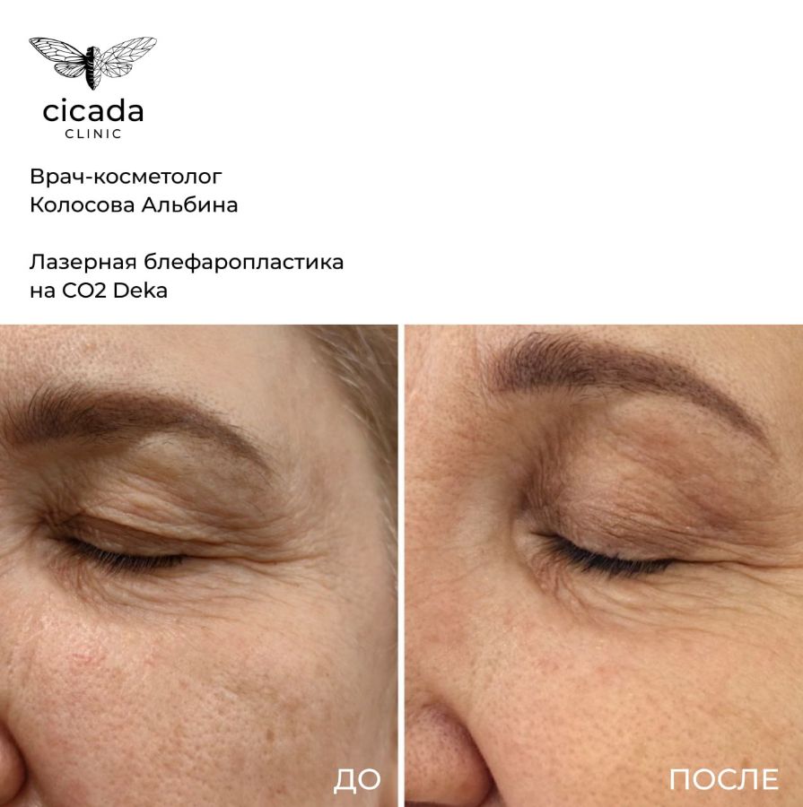 Записаться на процедуру Лазерная шлифовка - в Cicada Clinic